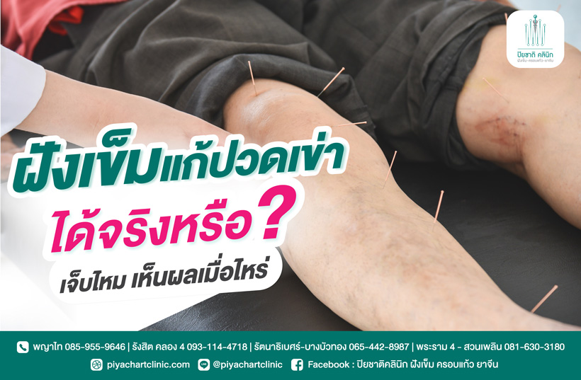 ฝังเข็มแก้ปวดเข่าได้จริงไหม ใช้เวลานานเท่าไหร่ถึงเห็นเห็นผล