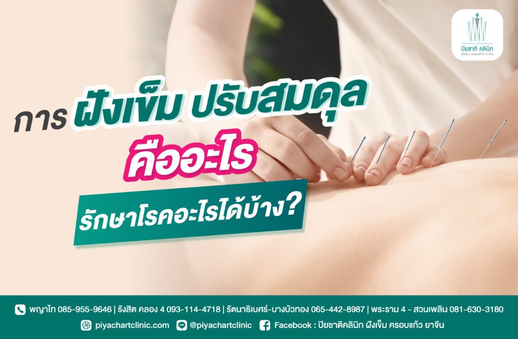 การฝังเข็ม ปรับสมดุล คืออะไร รักษาโรคอะไรได้บ้าง