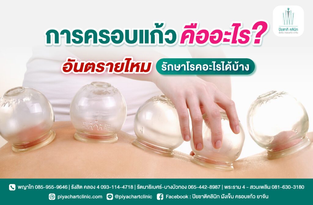 การครอบแก้วคืออะไร อันตรายไหม รักษาโรคอะไรได้บ้าง