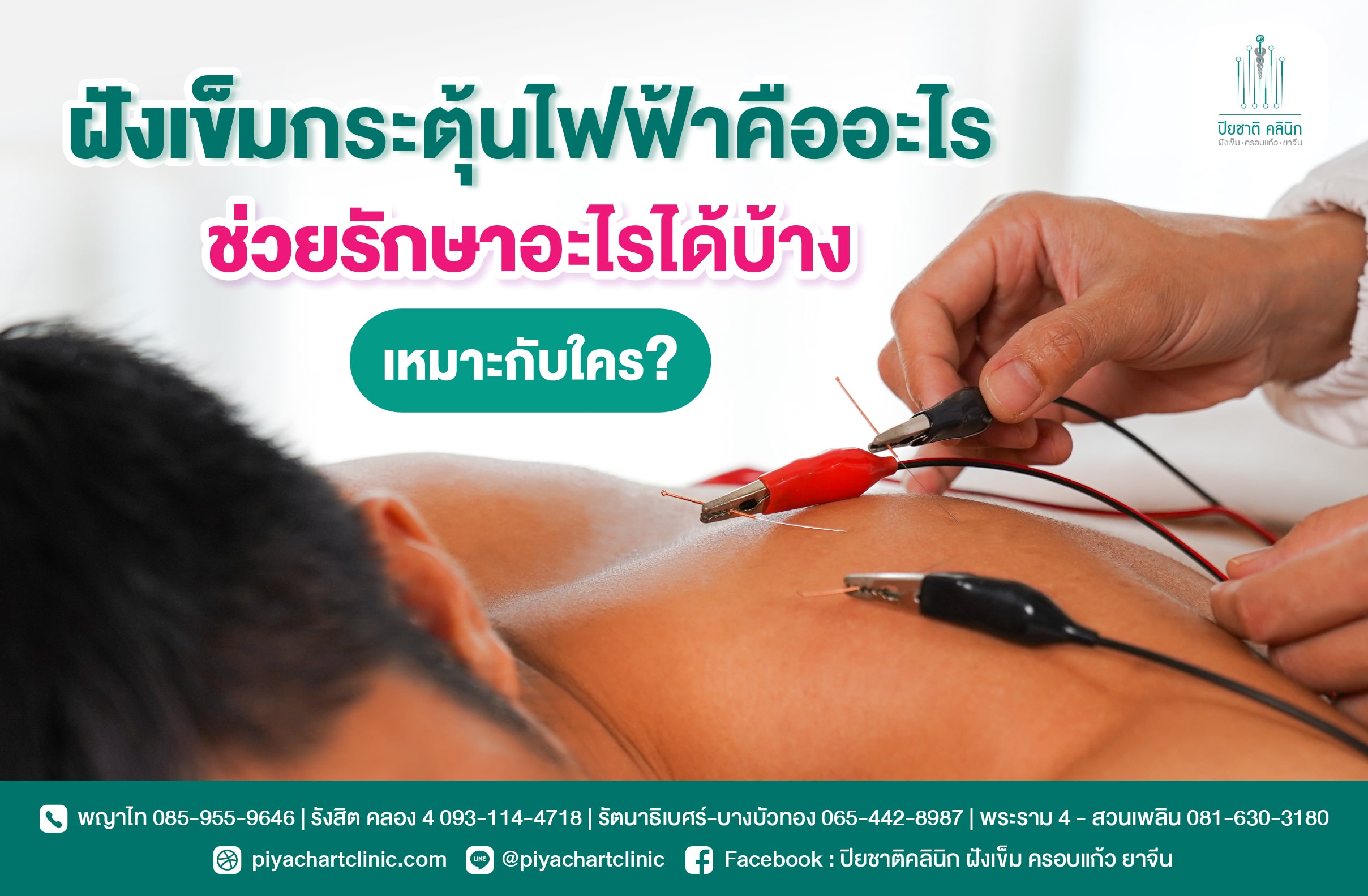 ฝังเข็มกระตุ้นไฟฟ้าคืออะไร ช่วยรักษาอะไรได้บ้าง เหมาะกับใคร?