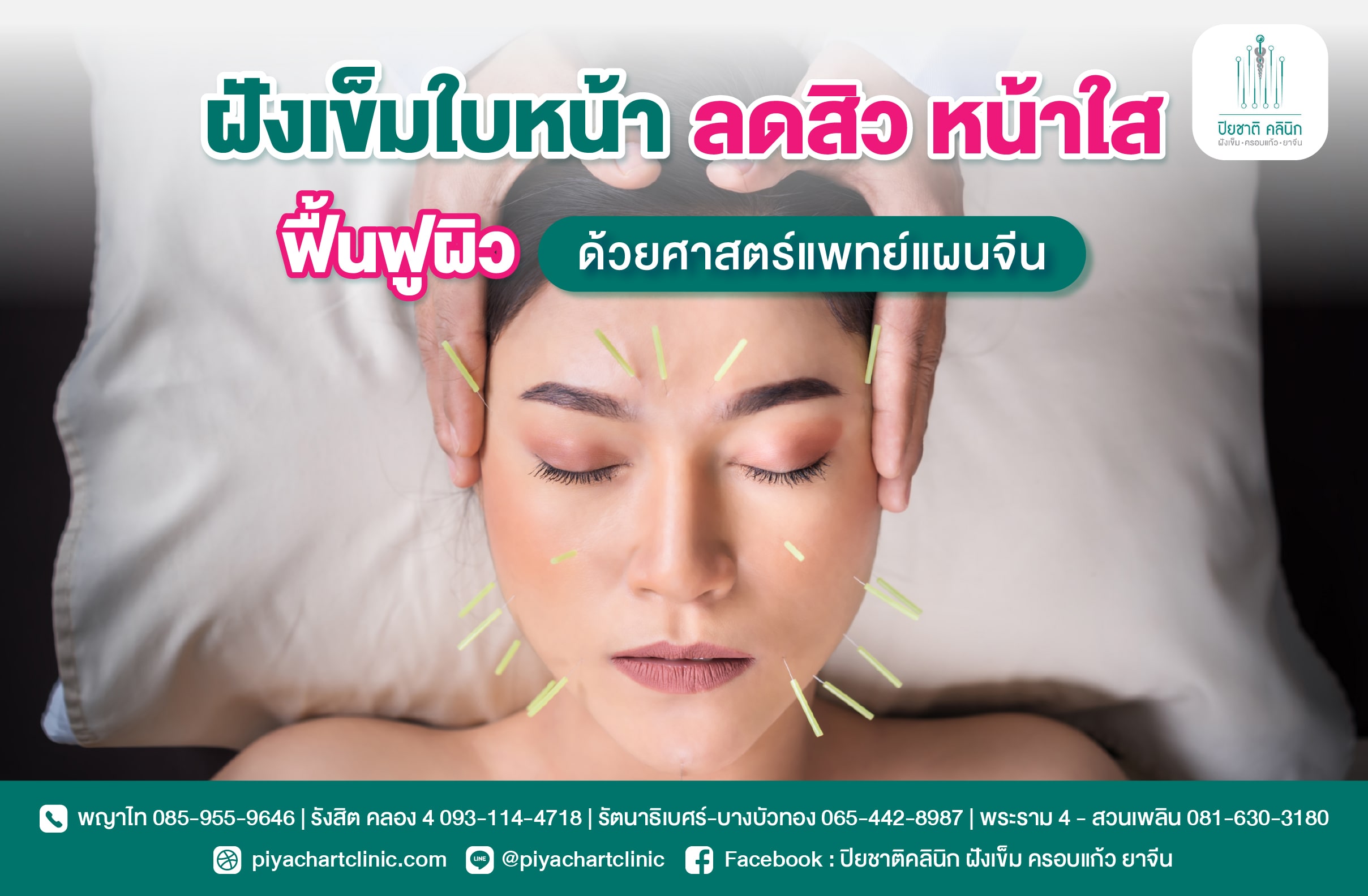 ฝังเข็มใบหน้า ลดสิว หน้าใส ฟื้นฟูผิวด้วยศาสตร์แพทย์แผนจีน
