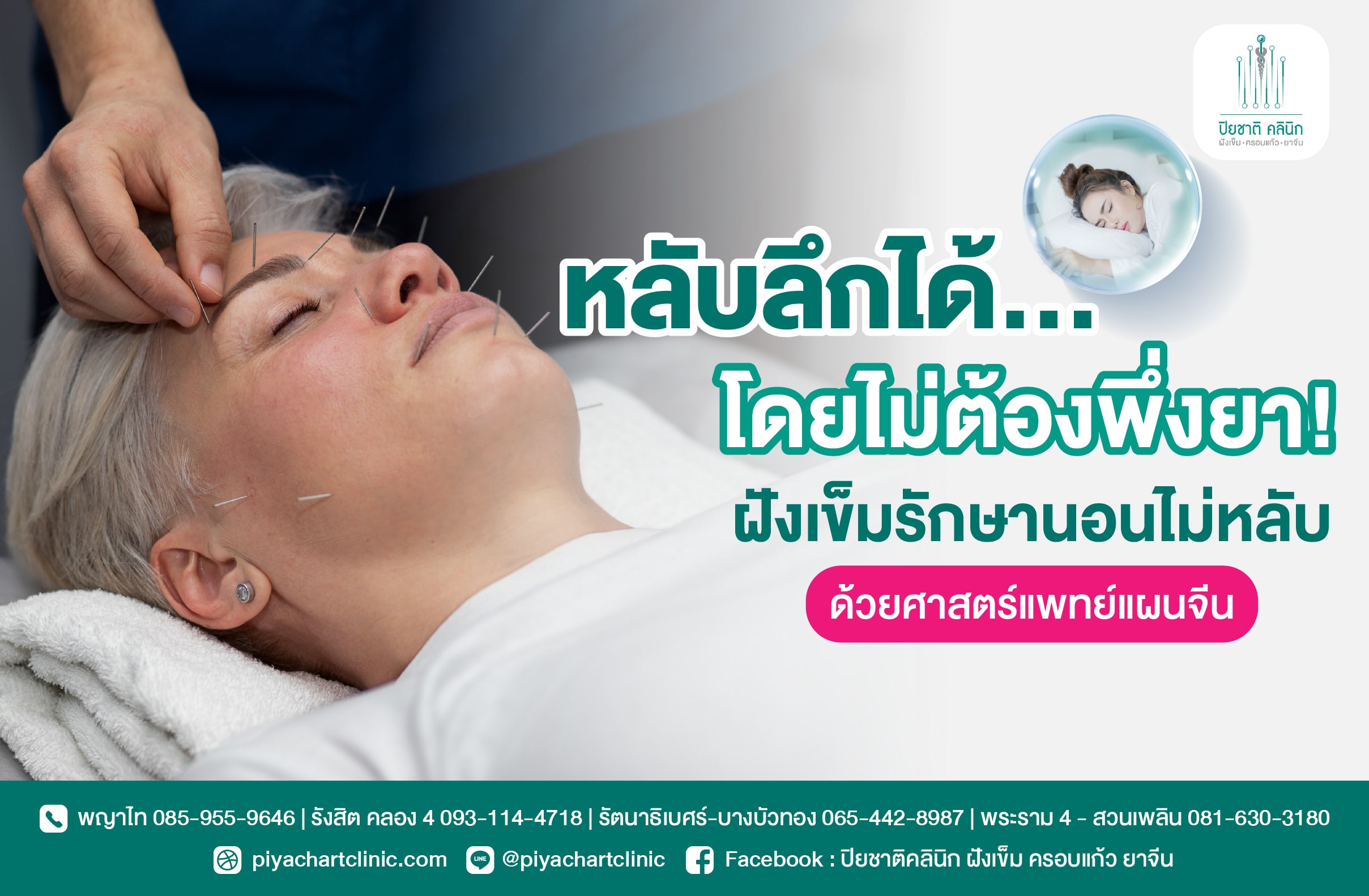 หลับลึกได้...โดยไม่ต้องพึ่งยา! ฝังเข็มรักษานอนไม่หลับด้วยศาสตร์แพทย์แผนจีน