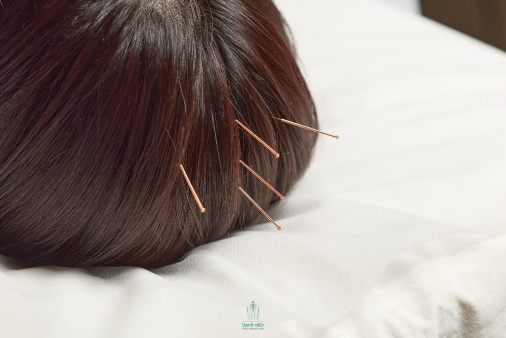 ฝังเข็มรักษา STROKE การฝังเข็มจะช่วยกระตุ้นการขยายตัวของหลอดเลือด (Vasodilation) ในหลอดเลือดสมองขนาดเล็กและกลาง โดยเฉพาะจุดฝังเข็มบริเวณท้ายทอยและต้นคอทั้งหมด รวมถึง 睛明， 太阳และข้างขมับ