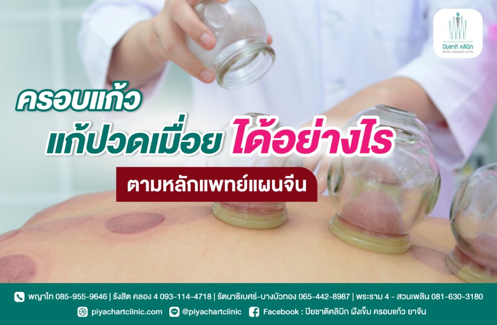 ครอบแก้วแก้ปวดเมื่อย ได้อย่างไร ตามหลักแพทย์แผนจีน
