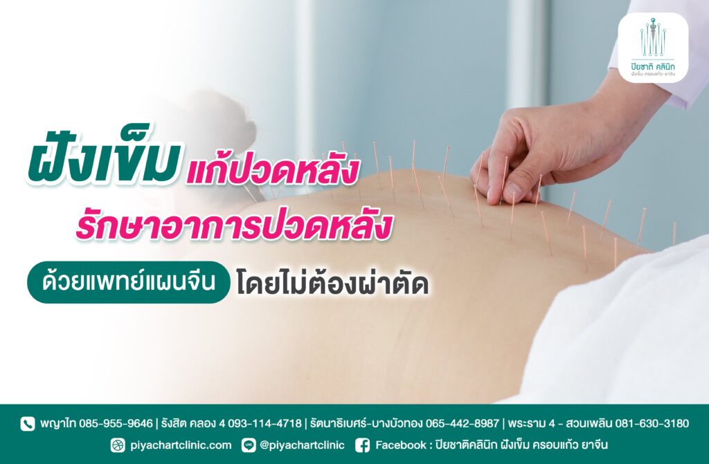 ฝังเข็มแก้ปวดหลัง รักษาอาการปวดหลังด้วยแพทย์แผนจีนโดยไม่ต้องผ่าตัด