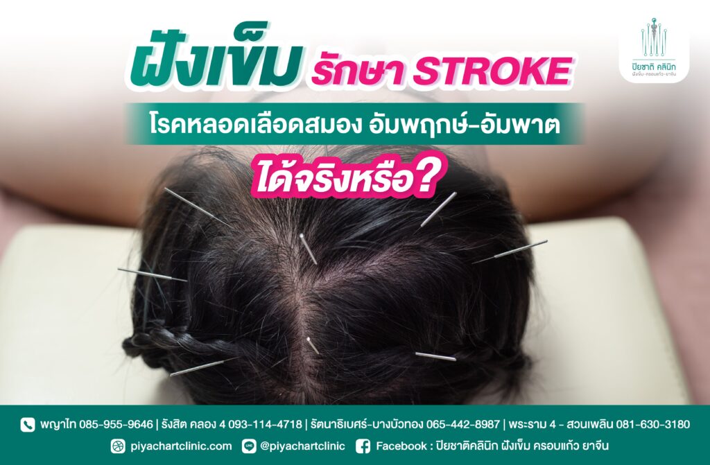 ฝังเข็มรักษา STROKE โรคหลอดเลือดสมอง อัมพฤกษ์-อัมพาตได้จริงหรือ ?