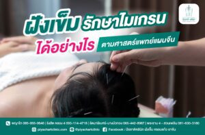 ฝังเข็มรักษาไมเกรนได้อย่างไรตามศาสตร์แพทย์แผนจีน?