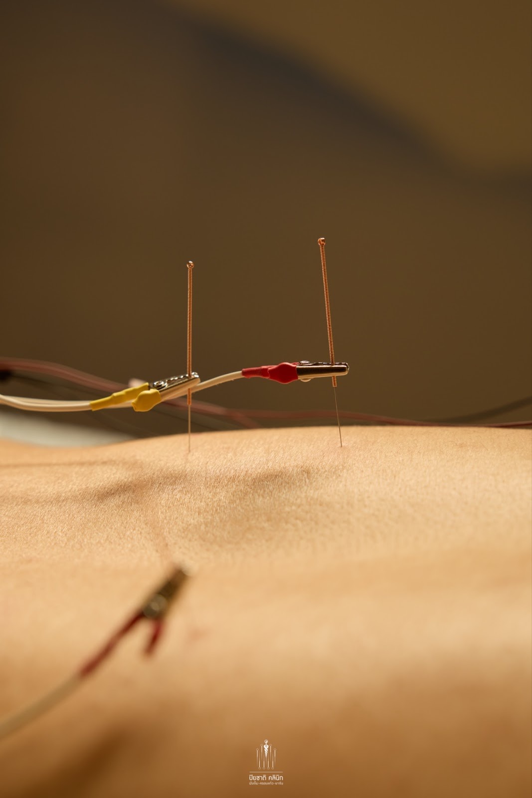 ฝังเข็มรักษา STROKE ระยะฟื้นฟู: ใช้การฝังเข็ม (针灸) เช่น 醒脑开窍, Scalp Acupuncture ร่วมกับการ 导引 ทำกายภาพบำบัด เพื่อกระตุ้นการทำงานของสมองและเส้นประสาท เสริมด้วยยาสมุนไพรจีน (中药) ที่ช่วยกระตุ้นการไหลเวียนเลือด สลายเสมหะ และบำรุงชี่เลือด