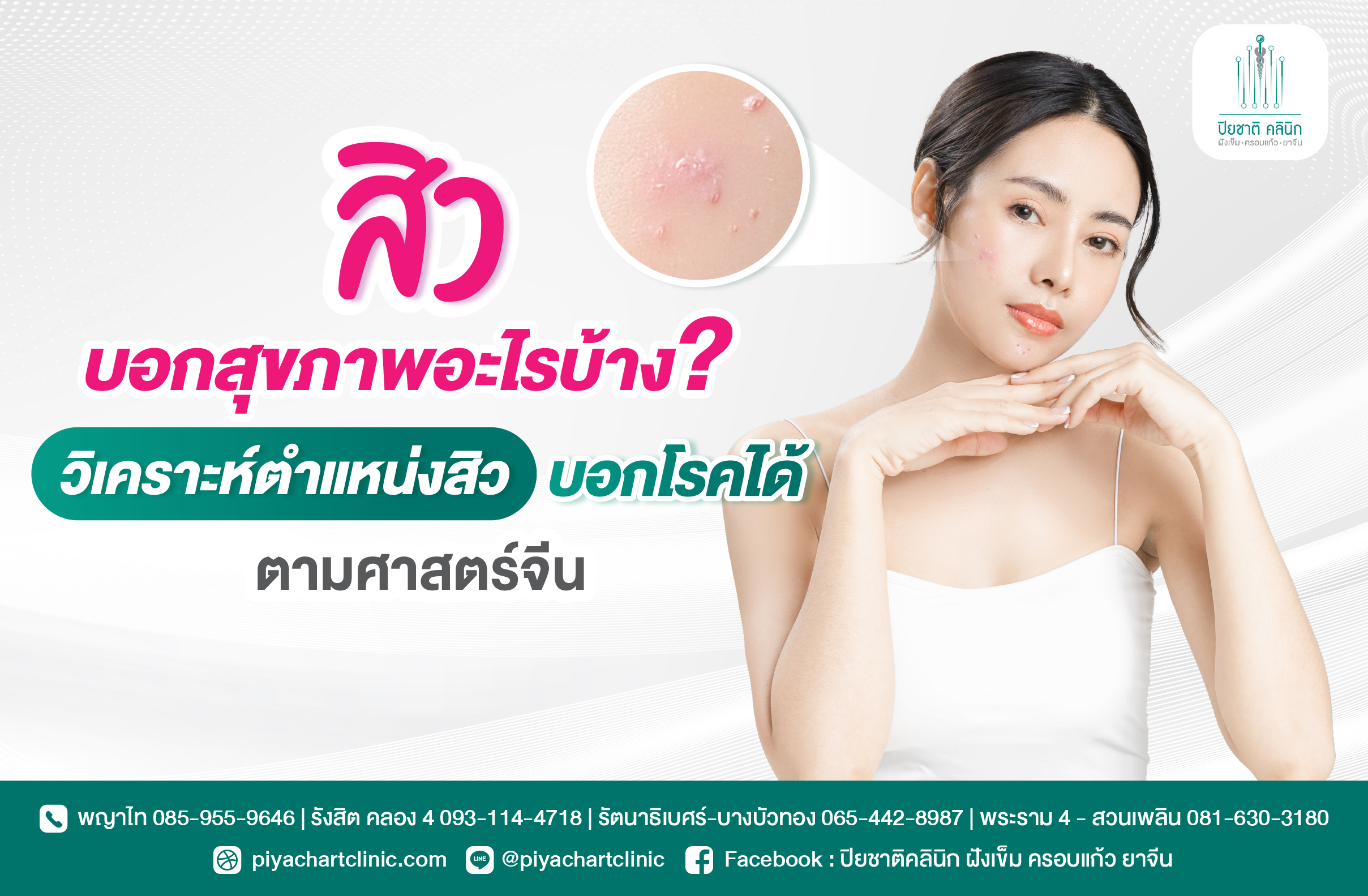 สิวบอกสุขภาพอะไรบ้าง? วิเคราะห์ตำแหน่งสิวบอกโรคได้ตามศาสตร์จีน