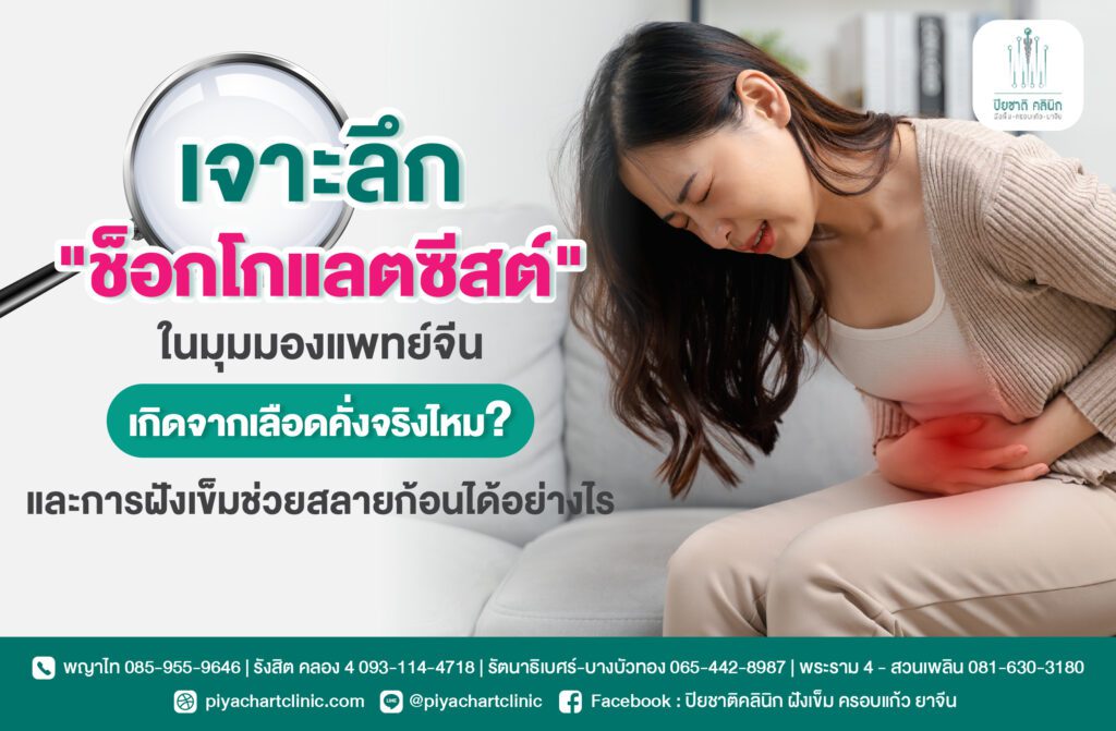 เจาะลึก "ช็อกโกแลตซีสต์" ในมุมมองแพทย์จีน เกิดจากเลือดคั่งจริงไหม? และการฝังเข็มช่วยสลายก้อนได้อย่างไร