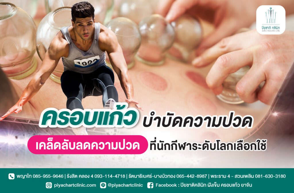 ครอบแก้วบำบัดความปวด เคล็ดลับลดความปวดที่นักกีฬาระดับโลกเลือกใช้