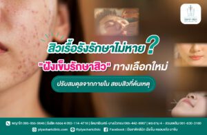 สิวเรื้อรังรักษาไม่หาย? "ฝังเข็มรักษาสิว" ทางเลือกใหม่ ปรับสมดุลจากภายใน สยบสิวที่ต้นเหตุ