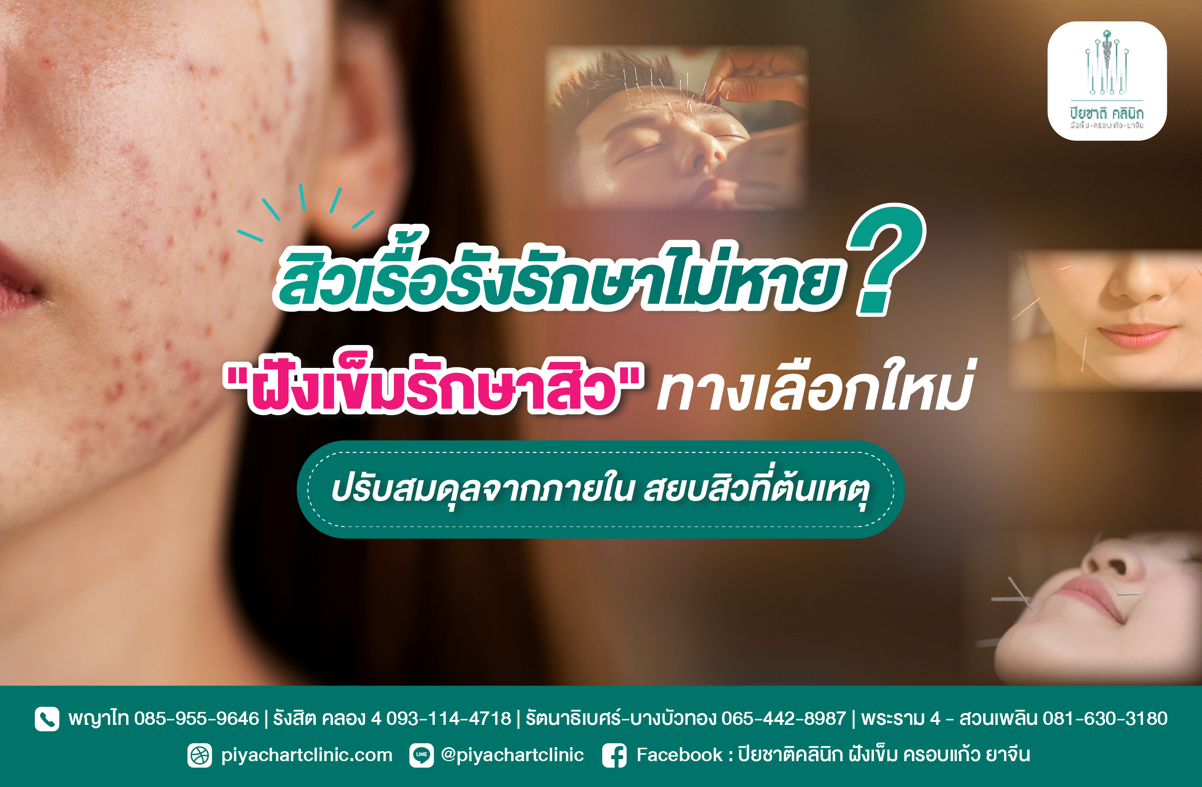สิวเรื้อรังรักษาไม่หาย? "ฝังเข็มรักษาสิว" ทางเลือกใหม่ ปรับสมดุลจากภายใน สยบสิวที่ต้นเหตุ