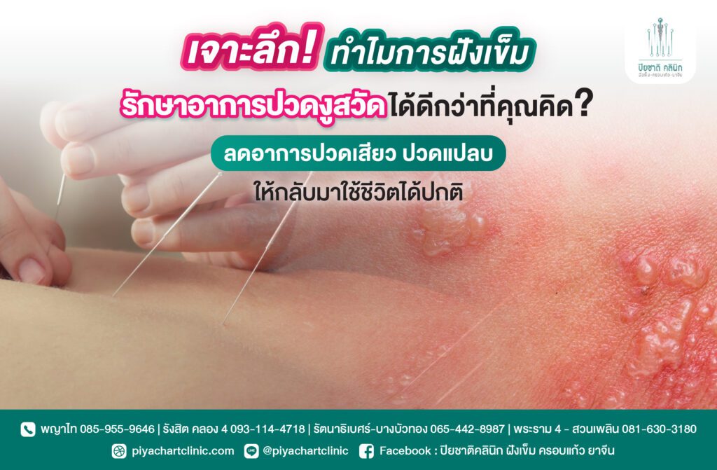 เจาะลึก! ทำไมการฝังเข็มรักษาอาการปวดงูสวัดได้ดีกว่าที่คุณคิด? ลดอาการปวดเสียว ปวดแปลบ ให้กลับมาใช้ชีวิตได้ปกติ