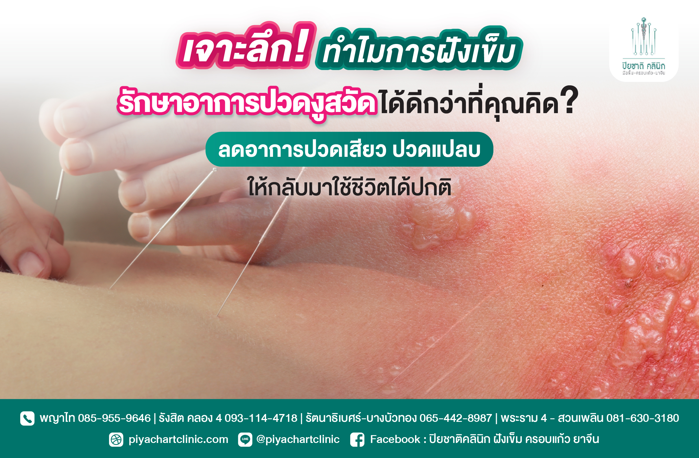 เจาะลึก! ทำไมการฝังเข็มรักษาอาการปวดงูสวัดได้ดีกว่าที่คุณคิด? ลดอาการปวดเสียว ปวดแปลบ ให้กลับมาใช้ชีวิตได้ปกติ