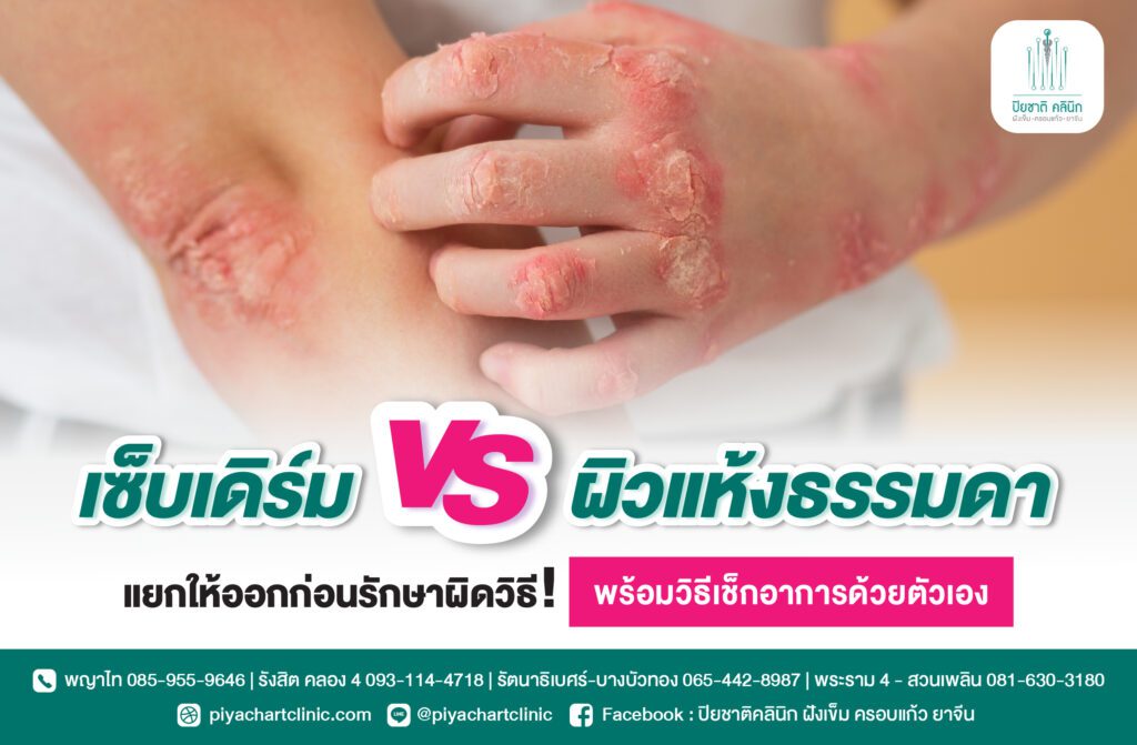 เซ็บเดิร์ม vs ผิวแห้งธรรมดา แยกให้ออกก่อนรักษาผิดวิธี! พร้อมวิธีเช็กอาการด้วยตัวเอง