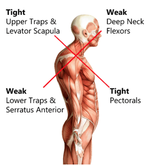 Office Syndrome คือ “กลุ่มอาการปวดเรื้อรัง” ที่เกิดจากการใช้ร่างกายซ้ำ ๆ ในท่าที่ไม่สมดุล เช่น: นั่งหน้าคอมเป็นเวลานาน คอยื่น ไหล่ห่อ หลังค่อม ใช้เมาส์/มือถือซ้ำ ๆ