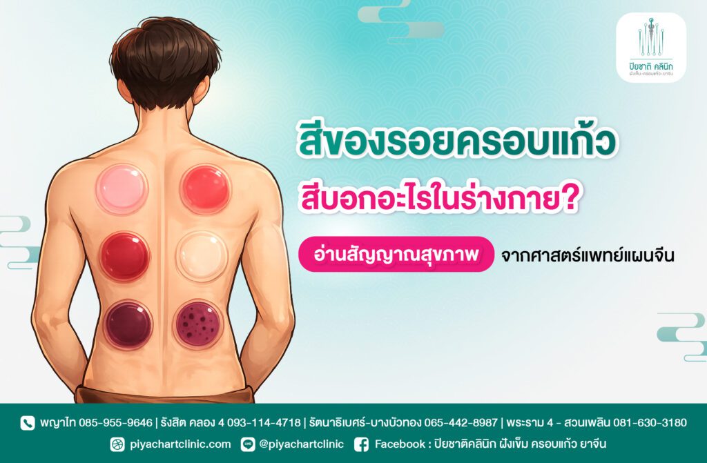 สีของรอยครอบแก้ว บอกอะไรในร่างกาย? อ่านสัญญาณสุขภาพจากศาสตร์แพทย์แผนจีน