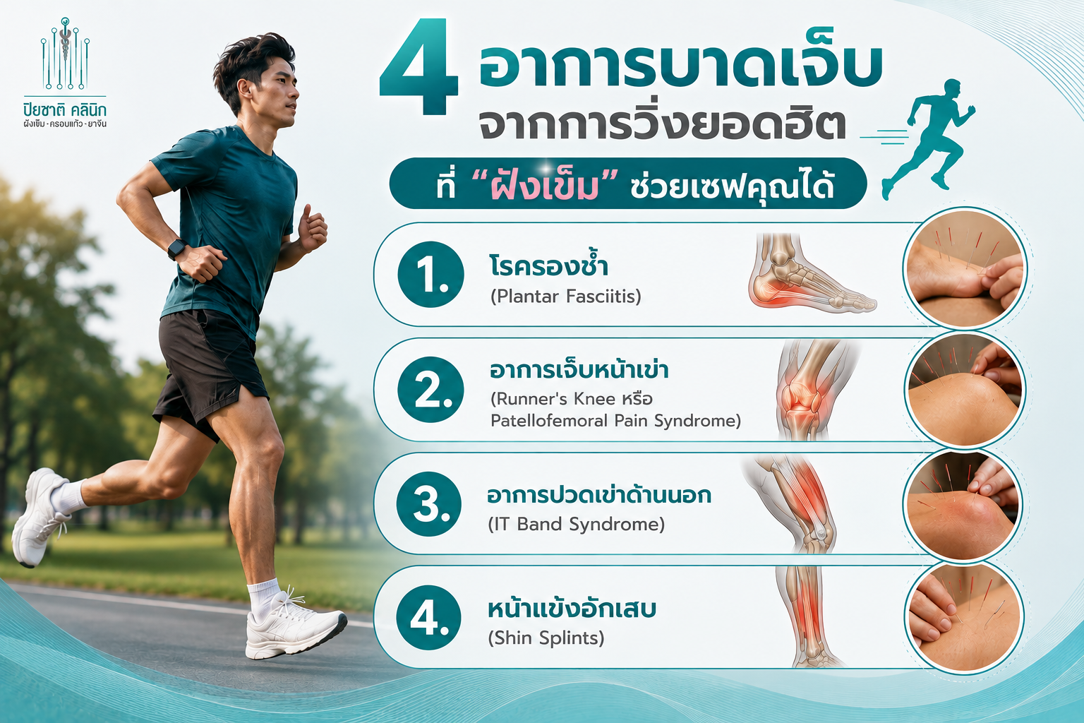 บาดเจ็บจากการวิ่ง ฝังเข็มรักษาได้! 1. โรครองช้ำ (Plantar Fasciitis) 2. อาการเจ็บหน้าเข่า (Runner's Knee หรือ Patellofemoral Pain Syndrome) 3. อาการปวดเข่าด้านนอก (IT Band Syndrome)  4. หน้าแข้งอักเสบ (Shin Splints)