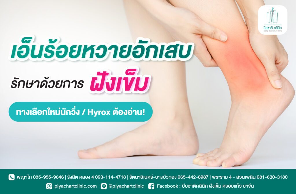 เอ็นร้อยหวายอักเสบ รักษาด้วยการฝังเข็ม ทางเลือกใหม่นักวิ่ง / Hyrox ต้องอ่าน!