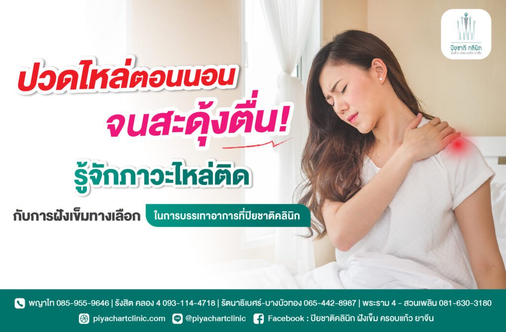 ปวดไหล่ตอนนอนจนสะดุ้งตื่น! รู้จักภาวะไหล่ติดกับการฝังเข็มทางเลือกรักษาที่ปิยชาติคลินิก