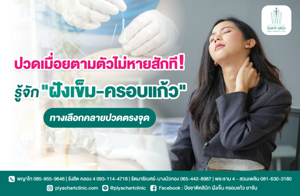 ปวดเมื่อยตามตัวไม่หายสักที! รู้จัก "ฝังเข็ม-ครอบแก้ว" ทางเลือกคลายปวดตรงจุด